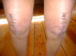 Knees with staples - it looks worse than it felt!